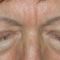 Operace očních víček (Blefaroplastika)