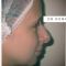 Rhinoplastie