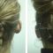 Ear surgery (Otoplasty)