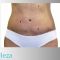 Abdominoplastika (Operácia brucha)
