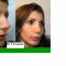 Rhinoplastie