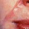 Laser Scar Treatment