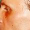 Plastika nosu (Rhinoplastika)