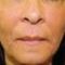 Kwas hialuronowy: Saypha, Restylane, Juvederm, Stylage