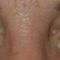 Eyelid surgery (Blepharoplasty)