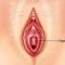 Hymenoplastie