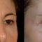 Blépharoplastie