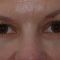 Teosyal, Restylane, Esthelis, Juverdem, Surgiderm (preparáty kyseliny hyaluronovej)