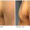 Gynecomastia (Male Breast Reduction)