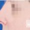 Operácia nosa (Rhinoplastika)