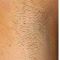 Electrolysis hair removal