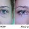 Laserové zákroky estetickej dermatológie