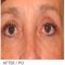 Eyelid surgery (Blepharoplasty)