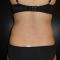 Liposukcia laserová - SmartLipo