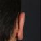 Ear surgery (Otoplasty)