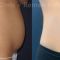 Miniabdominoplastika