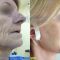 Lifting du visage
