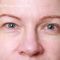 Eyelid surgery (Blepharoplasty)