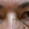 Operácia očných viečok (Blepharoplastika)