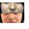 Rhinoplastie