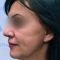 Facelift, SMAS Facelift