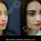 Rhinoplastie secondaire
