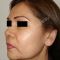 Lifting facial