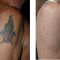 Rimozione tatuaggi - laser