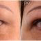 Operácia očných viečok (Blepharoplastika)