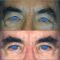 Blépharoplastie