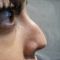 Rhinoplastie médicale