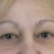 Eyelid surgery (Blepharoplasty)
