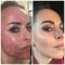 Fotorejuvenace / Resurfacing