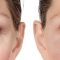 Operácia očných viečok (Blepharoplastika)