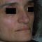 Rhinoplastie