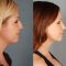 Operácia nosa (Rhinoplastika)