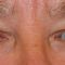 Korekcja powiek (Blepharoplastyka)