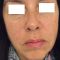 Ultherapy (Lifting non chirurgico)