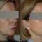 Lifting du visage