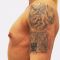 Breast Augmentation - Breast Implants