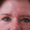 Eyelid surgery (Blepharoplasty)