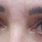 Operácia očných viečok (Blepharoplastika)