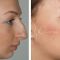 Rhinoplasty (Nose Job)