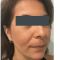 Peeling chimico