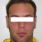 Operazione orecchie (Otoplastica)
