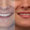 Hyaluronic acid-based wrinkle fillers