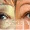 Operácia očných viečok (Blepharoplastika)