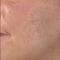 Scar removal