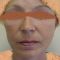 Facelift, SMAS Facelift