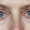 Dermal fillers